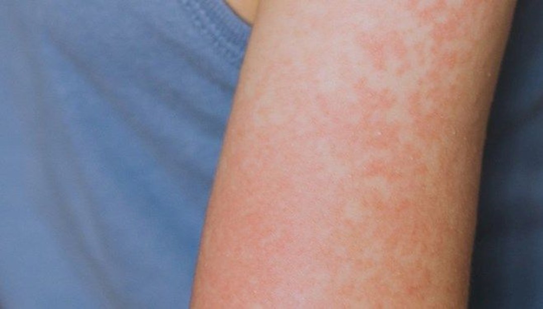 Teksas’ta ilk ölüm gerçekleşti: Aşısız çocuk kızamıktan hayatını kaybetti